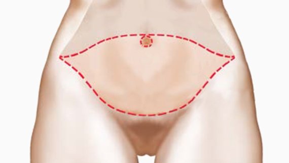 Gaine de contention post-abdominoplastie : Quel est son rôle ?